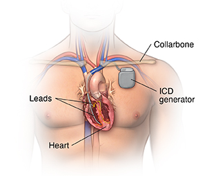 Front view of male chest showing implantable cardioverter defibrillator.